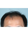 Before Hair Transplant &nbsp;2 Sessions (Areas)